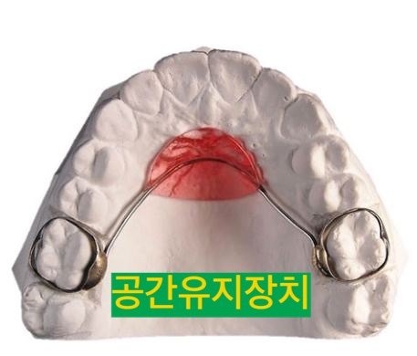 양쪽을 연결한 낸스 공간유지장치 모형