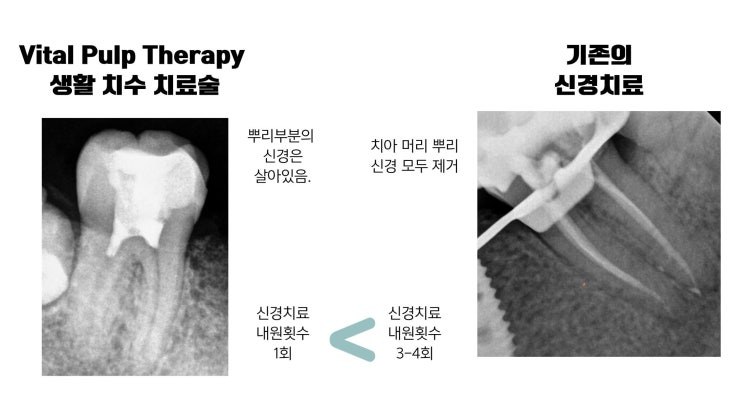 생활치수치료와 기존 신경치료 비교