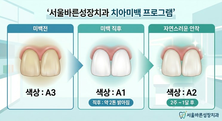 미백 전 A3, 직후 A1, 안정기 A2 색상 변화